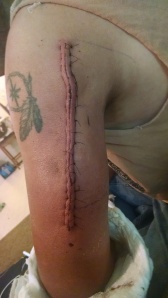 Caleb's arm after surgery, a little over a foot long! Taken 9-1-2014